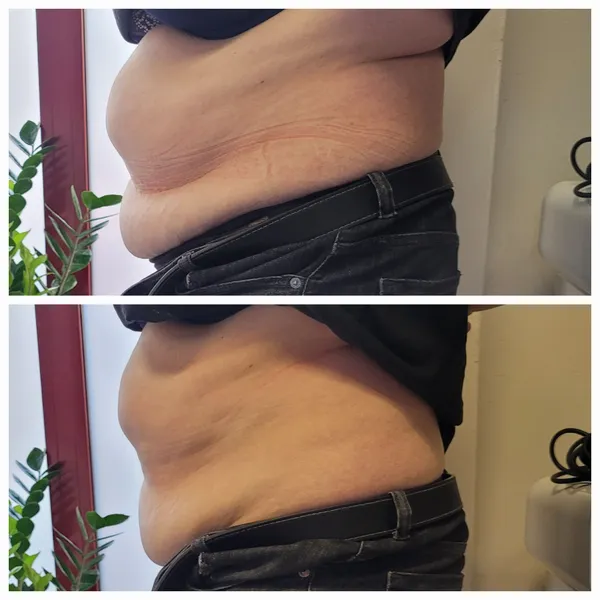 Efekt zabiegu liposukcji laserowej Vivien 1064 nm