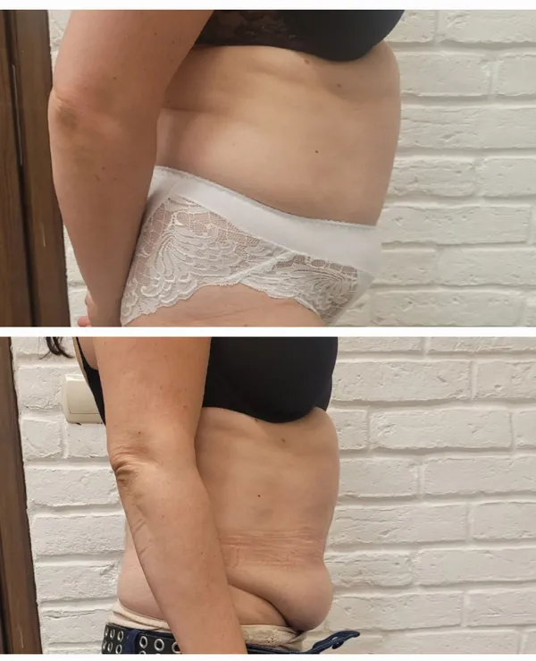 Efekt zabiegu liposukcji laserowej Vivien 1064 nm